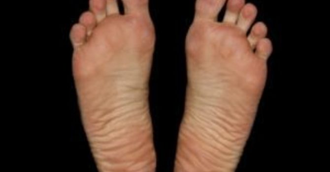 The Facts About Plantar Fasciitis image