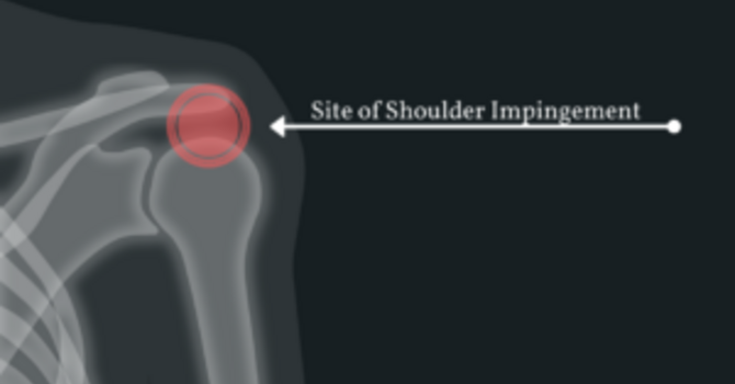 Shoulder Impingement image